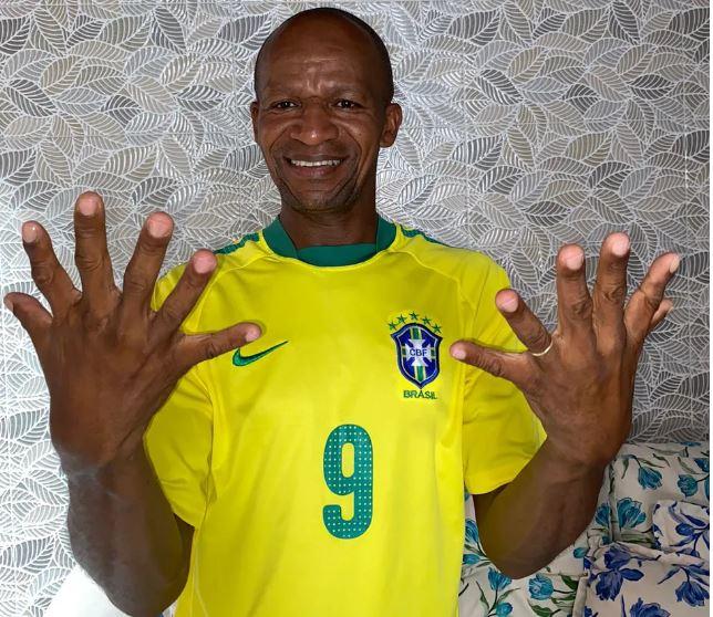 Homem com seis dedos pretende comemorar hexa com uma mão só