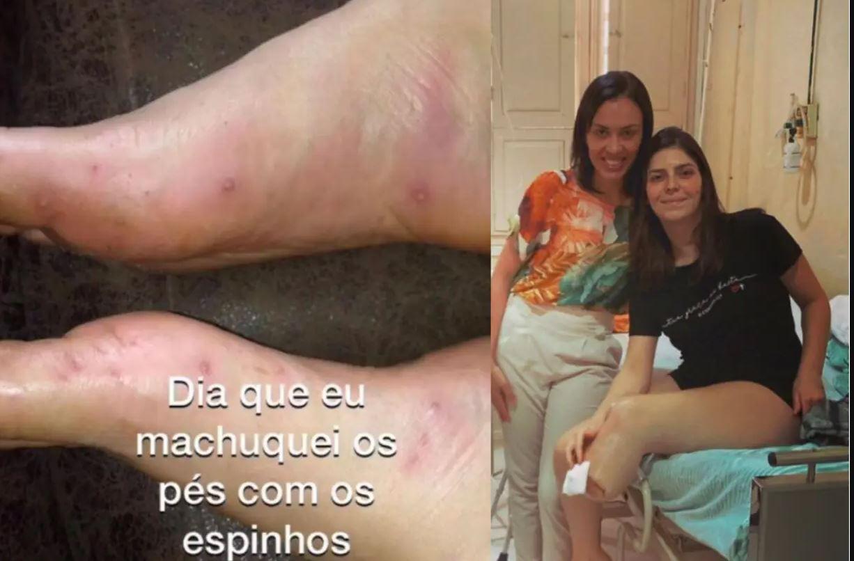 Mulher pisa em espinho e acaba com problema no coração e perna amputada