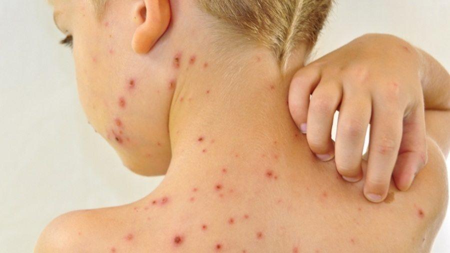 Sarampo se torna ameaça global iminente devido à pandemia, segundo OMS