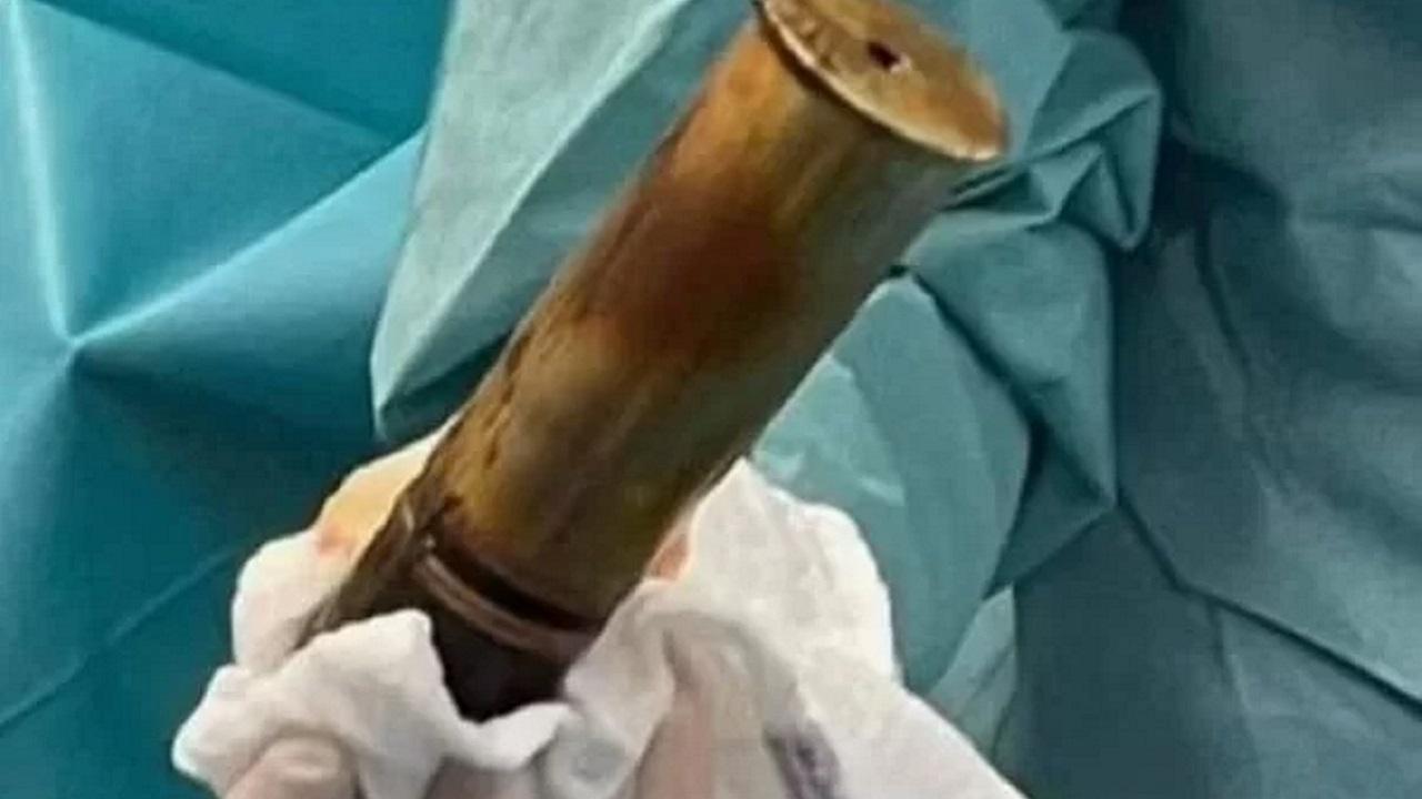 Hospital é evacuado na França após homem de 88 anos dar entrada na emergência com uma bomba no reto