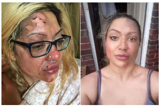 Em Manchester, na Inglaterra, mulher tem rosto queimado após fazer trend do ovo cozido do TikTok