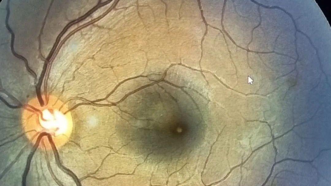 Jovem de de 22 anos é diagnosticada em Natal RN, com lesão no olho após ver eclipse solar sem proteção