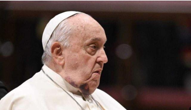 Papa Francisco aparece com queixo roxo em cerimônia no Vaticano