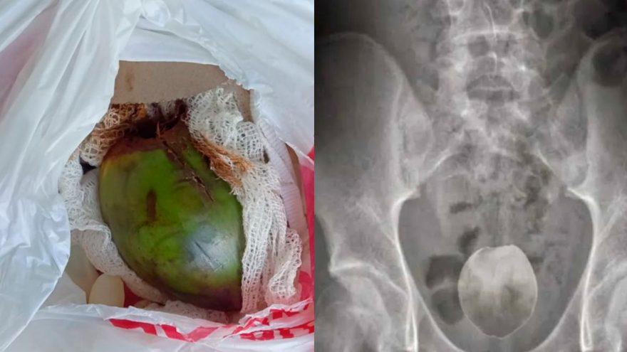 Homem dá entrada no hospital após introduzir coco verde no ânus