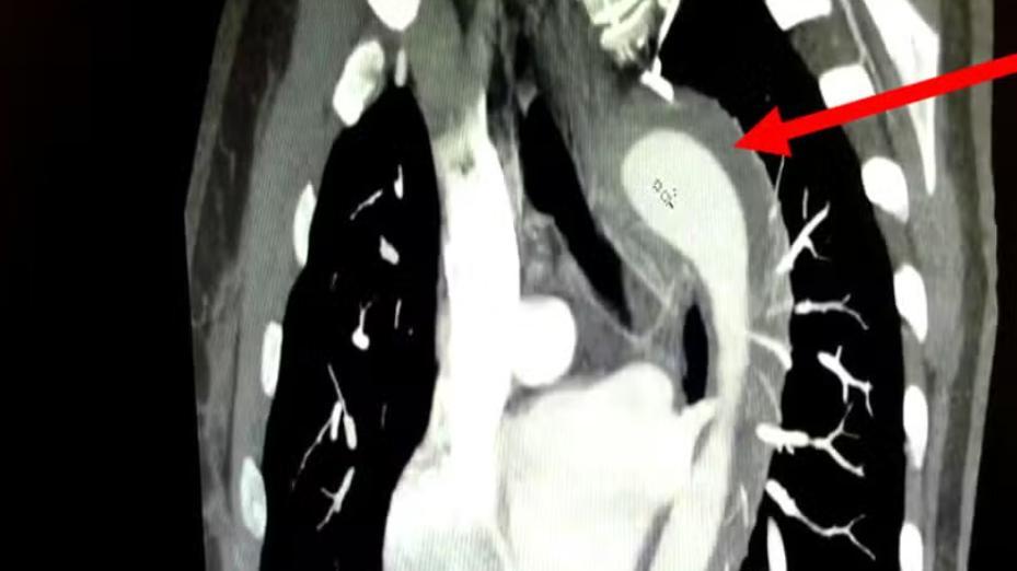 Mulher rompe aorta durante orgasmo e é levada à emergência em caso raro